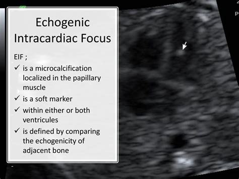 echogenic intracardiac focus patient handout.